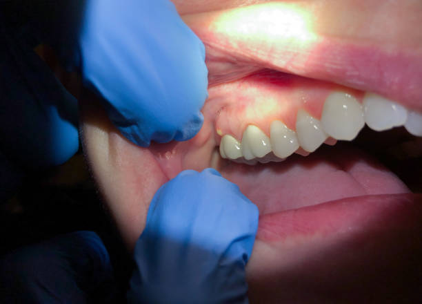 Best Broken or Cracked Tooth Emergency Dentist in Athens, GA